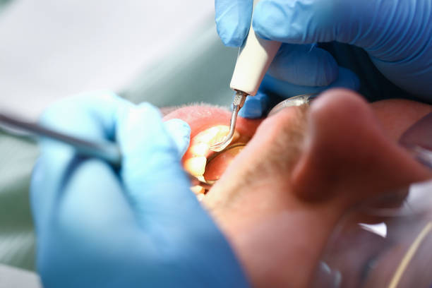 Best Emergency Treatment for Dental Infections or Abscesses in Calhoun City, MS
