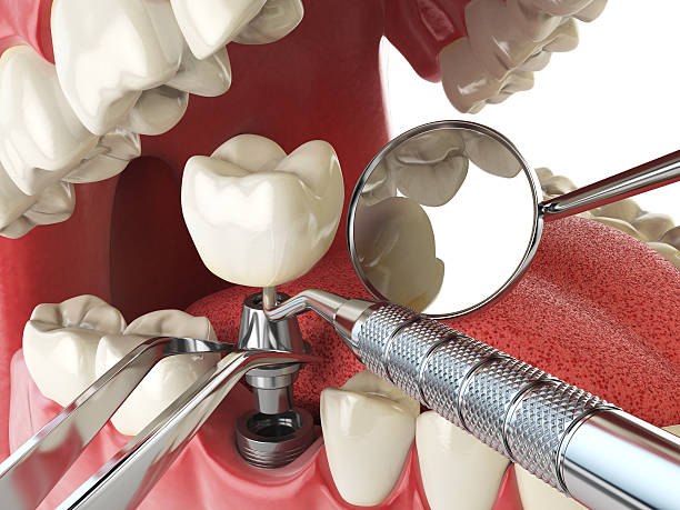 Best Emergency Tooth Extraction in Calhoun City, MS